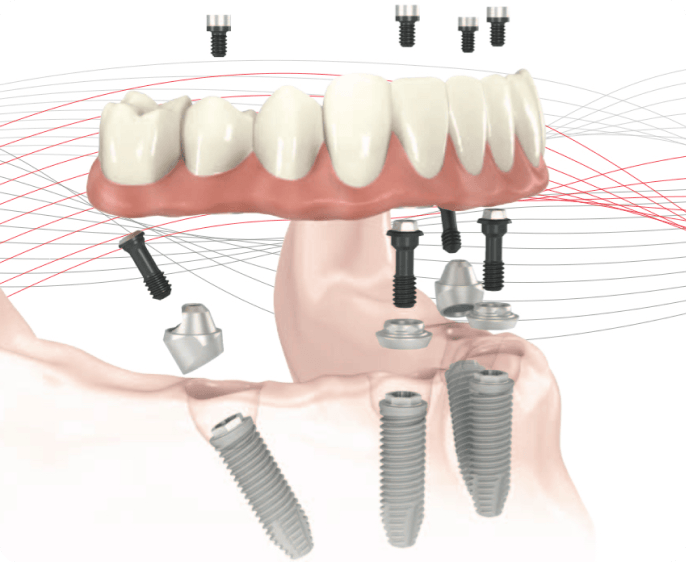 All on 4 Implant
